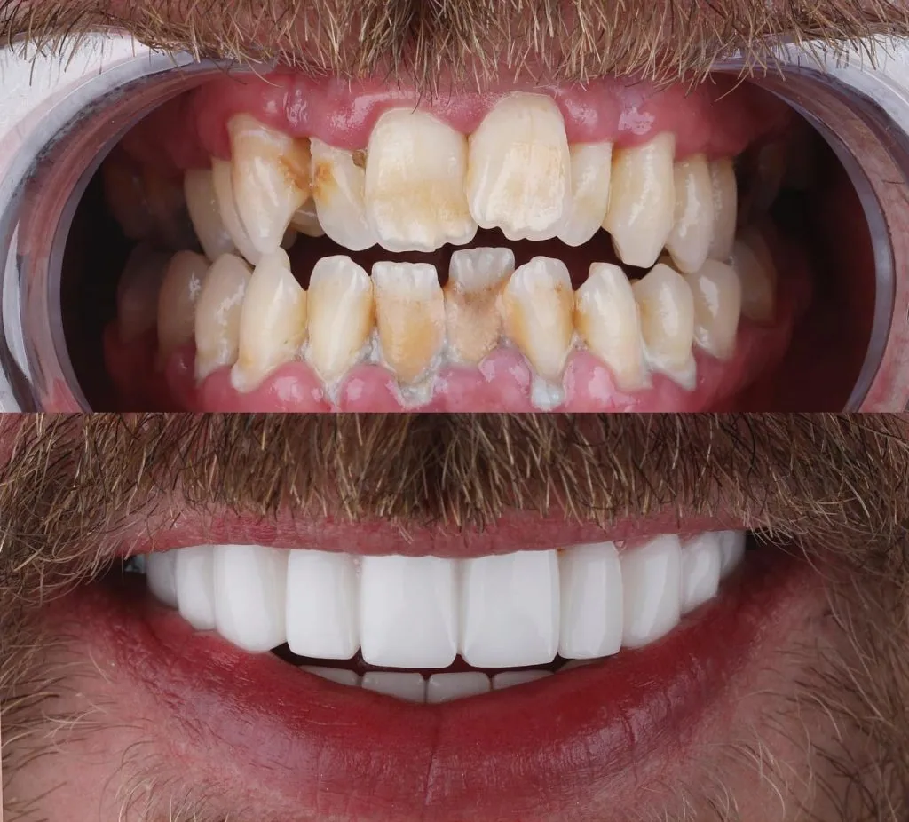 Implant 3