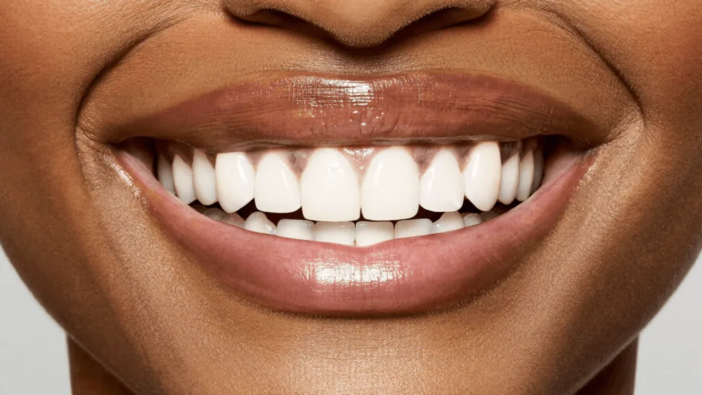 Close-up of a bright, even smile with eMax laminate veneers in Antalya