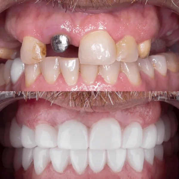 Dental implants in antalya amazing smile turkey