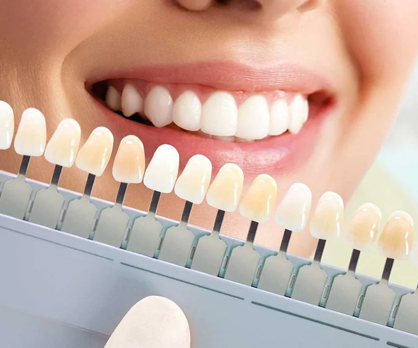 Composite Bonding