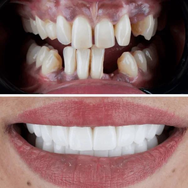 Dental implants in antalya amazing smile turkey