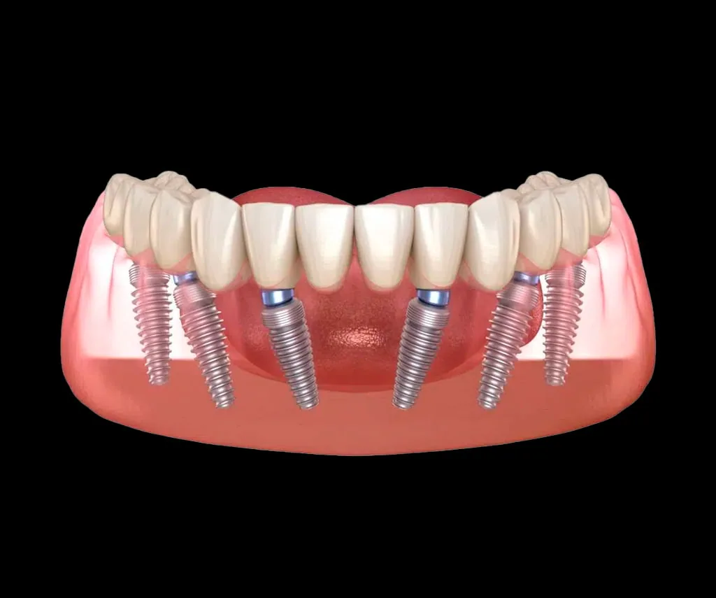 All on 6 Dental Implants