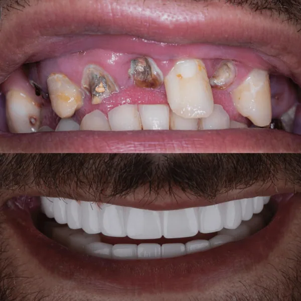 Dental implants in antalya amazing smile turkey