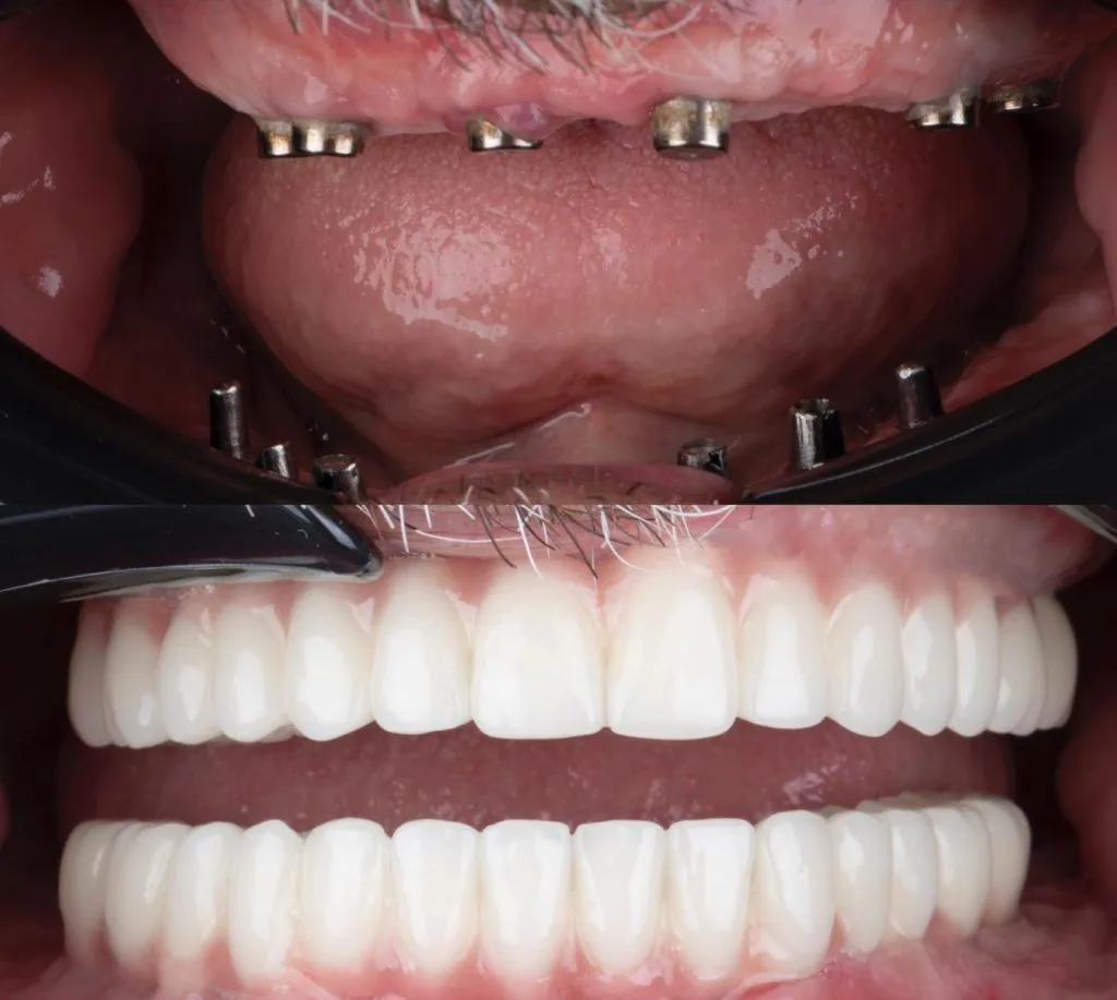 Implant 2
