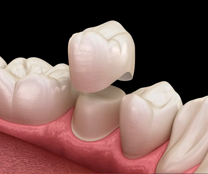 Dental Crowns in Turkey