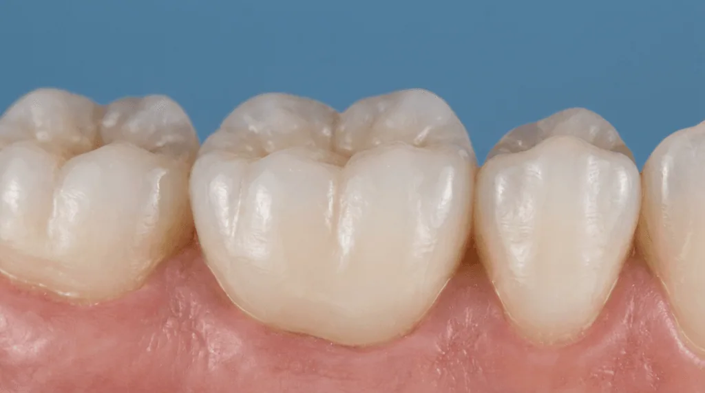 Zirconia crown Turkey