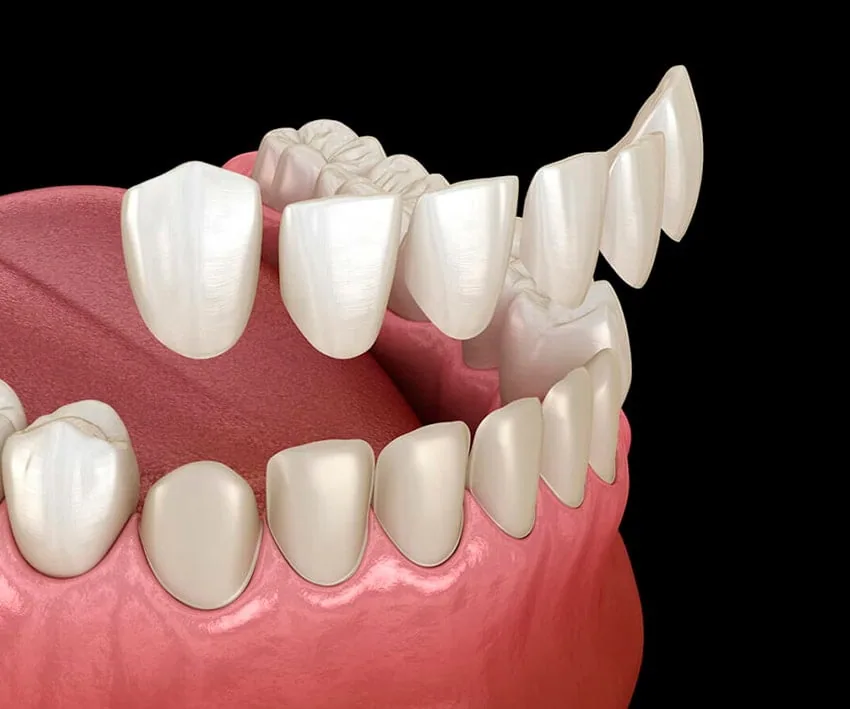 Emax Laminate Veneers