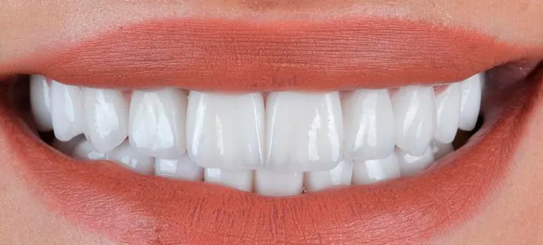 Composite bonding Turkey before and after for UK patients in Antalya