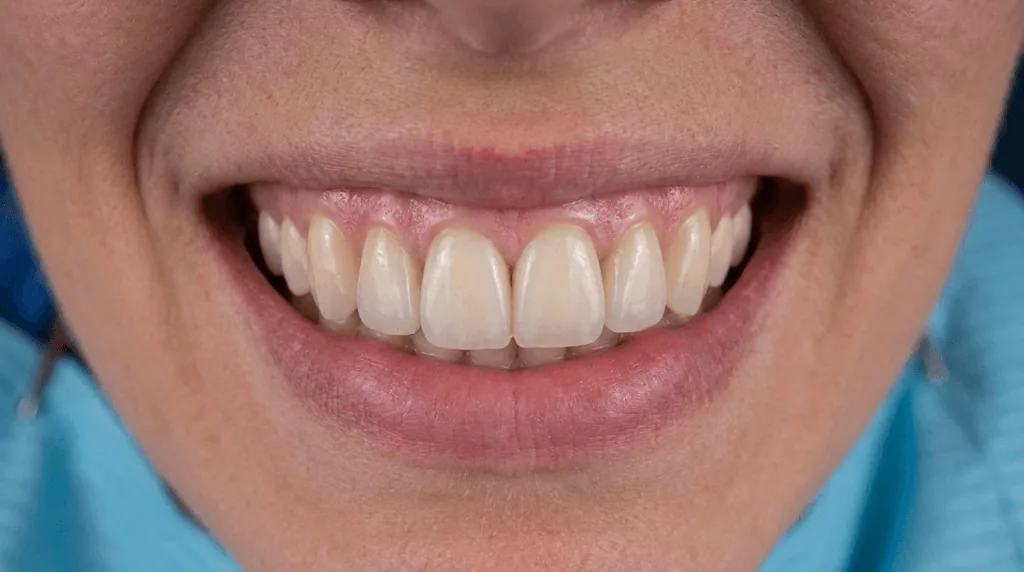 Dental crowns Turkey
