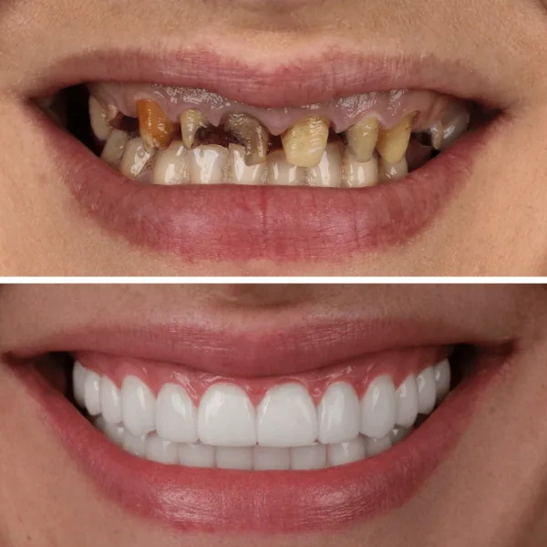 Dental implants in antalya amazing smile turkey