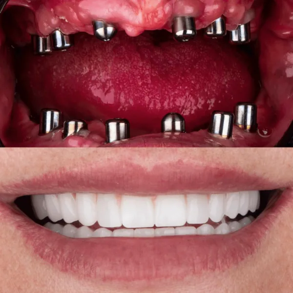 Dental implants in antalya amazing smile turkey