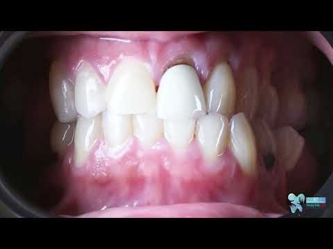 Our patient got his new smile with 27 Zirconium Crowns  and 4 Dental Implants