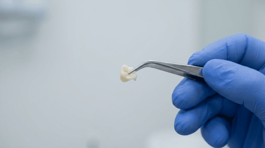 Dentist holding a ceramic dental inlay restoration with tweezers in a Turkey clinic