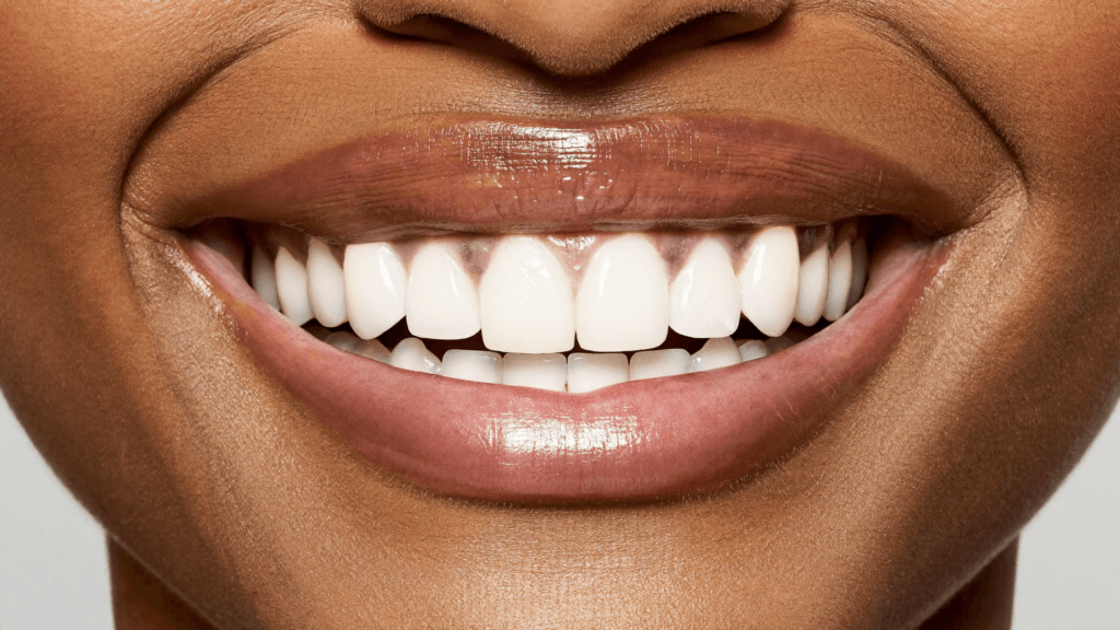 Close-up of a bright, even smile with eMax laminate veneers in Antalya