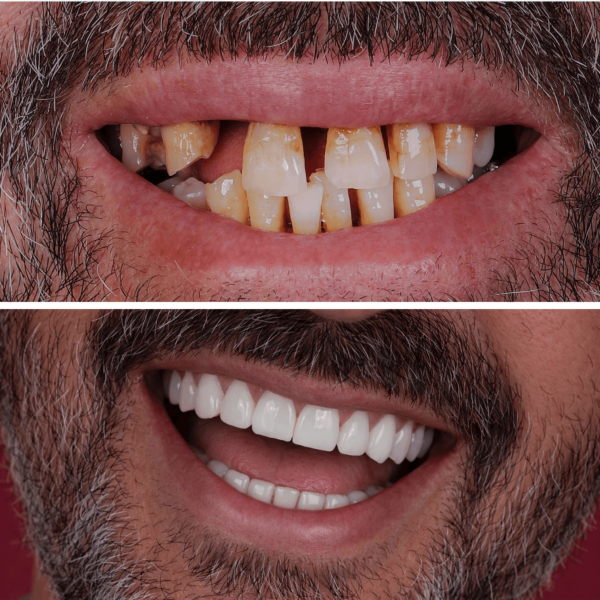 dental-implants-in-antalya-amazing-smile-turkey-20261