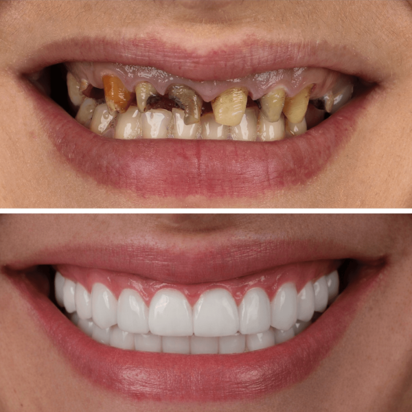 dental-implants-in-antalya-amazing-smile-turkey-20262