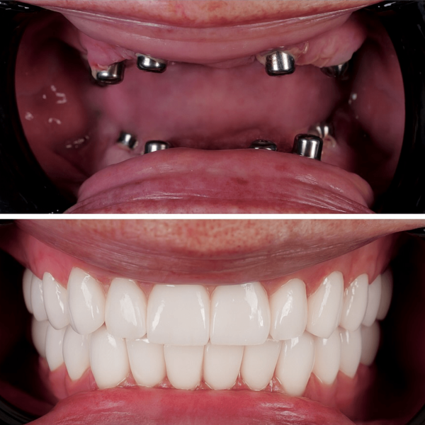 dental-implants-in-antalya-amazing-smile-turkey-20263