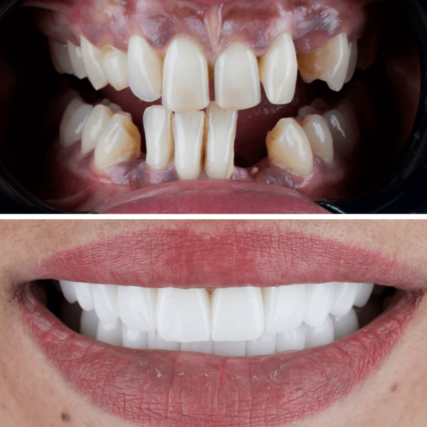 dental-implants-in-antalya-amazing-smile-turkey-20264