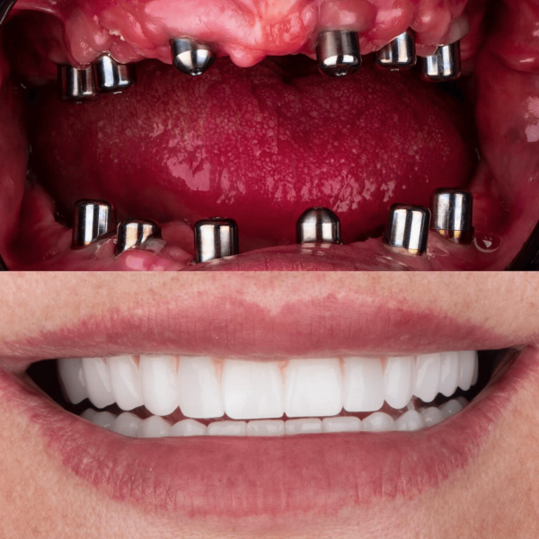 dental-implants-in-antalya-amazing-smile-turkey-20265