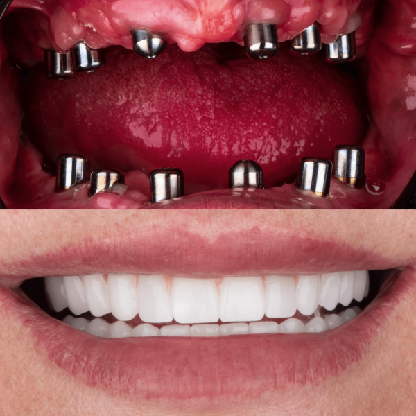 Dental implants in antalya amazing smile turkey