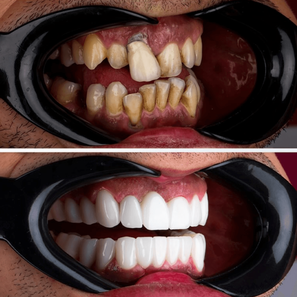 dental-implants-in-antalya-amazing-smile-turkey-20266