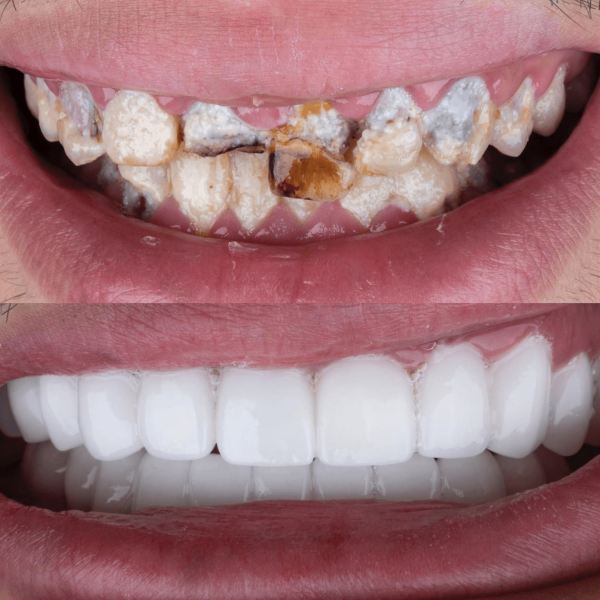 dental-implants-in-antalya-amazing-smile-turkey-20267