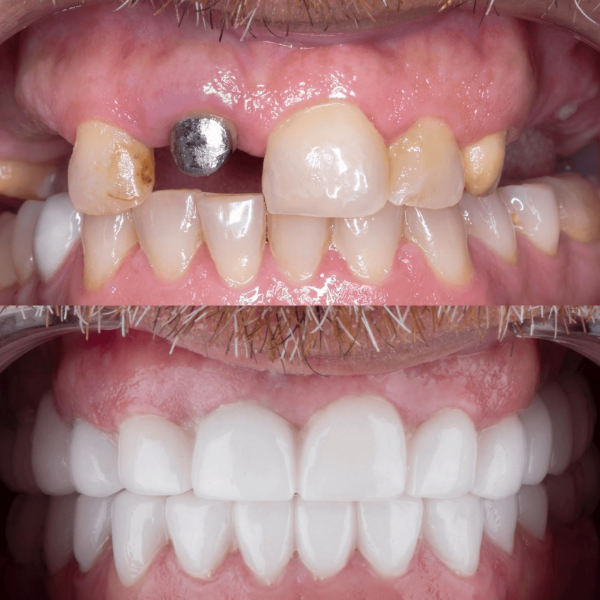 dental-implants-in-antalya-amazing-smile-turkey-20268