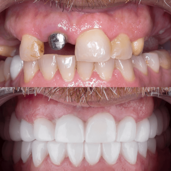 Dental implants in antalya amazing smile turkey
