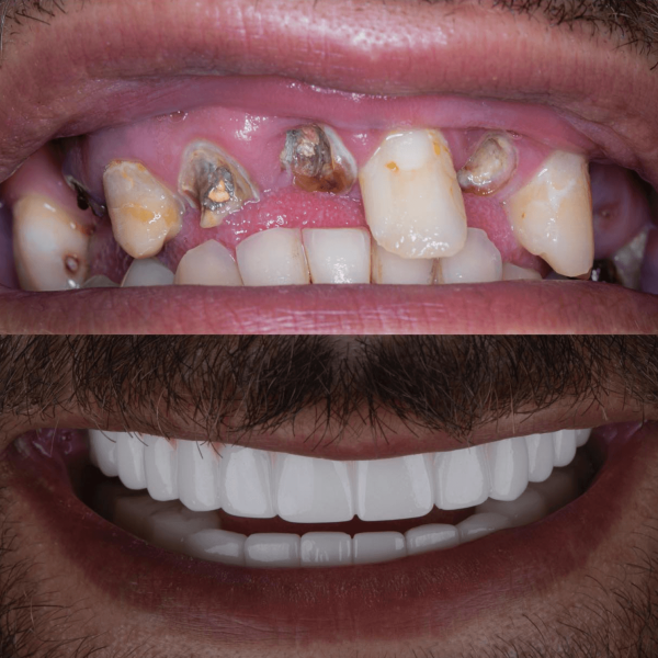 dental-implants-in-antalya-amazing-smile-turkey-20269